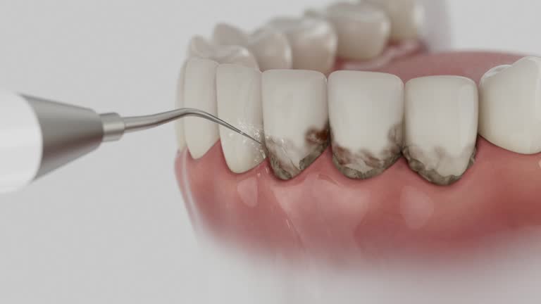 Trusted Wisdom Tooth Removal service in Geneva, IN - Dentist Open Now